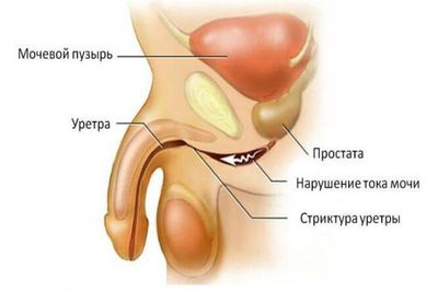 неспецифический уретрит