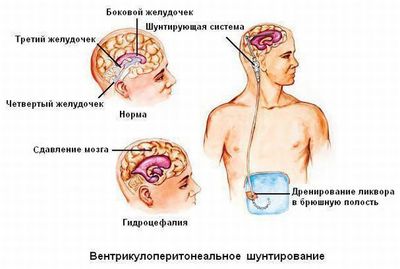 Вентрикулоперитонеальный шунт