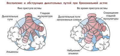 астматический статус