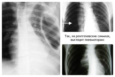 пневмоторакс на рентгене