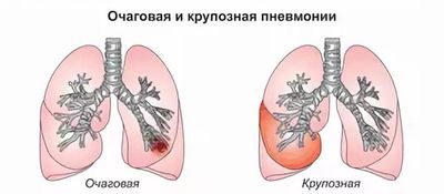 виды пневмонии