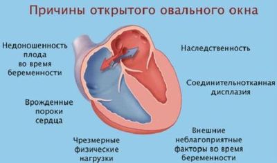 Схема, поясняющая почему может формироваться открытое овальное окно