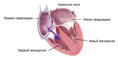 Открытое овальное окно: норма или сердечный порок?