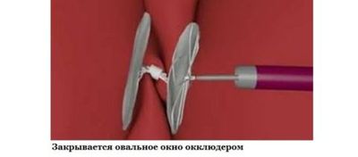 Перекрытие окна в межсердечной перегородки эндоваскурярными методиками