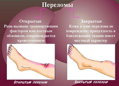Первая помощь при открытом переломе