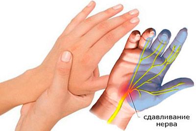 сдавливание