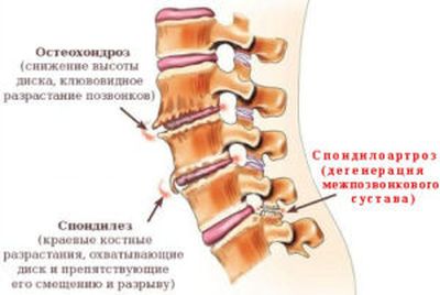 Спондилоартроз