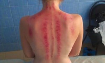 Синяки после массажа