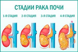Злокачественные новообразования почечных лоханок