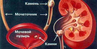 причины темной мочи у мужчин - камни на схеме