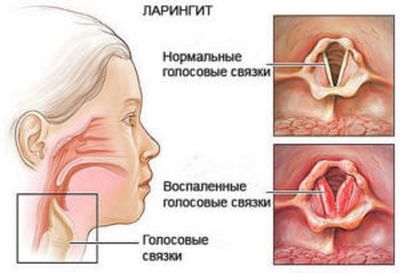 Ларингит и ангина