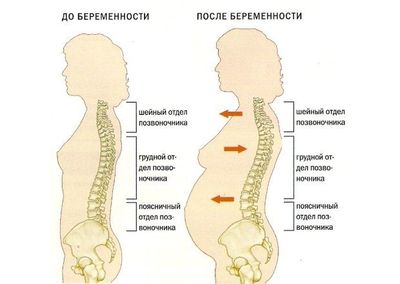 Остеохондроз в период беременности