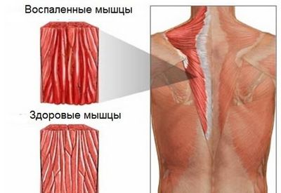 Миозит мышечный