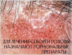 При себорейном дерматите головы показана комплексная терапия