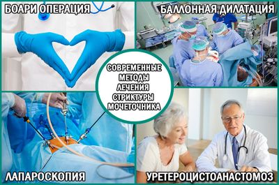 Стриктура мочеточника: современные методы лечения