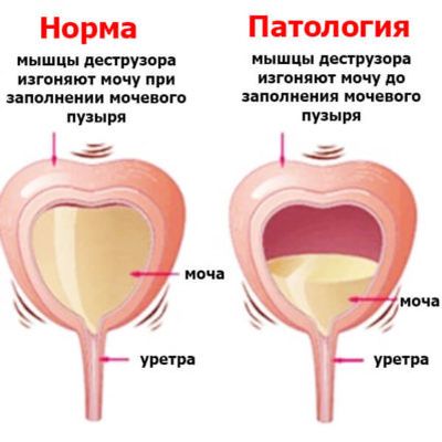 синдром раздраженного мочевого пузыря на схеме