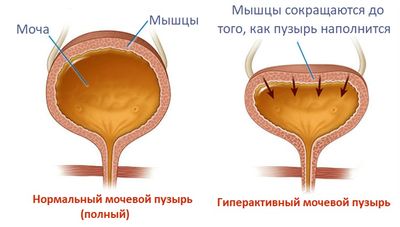 Гиперактивный мочевой пузыря