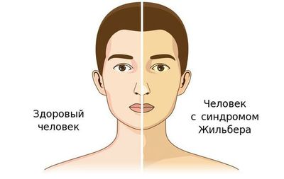 Болезнь Жильбера: что это такое, как лечить