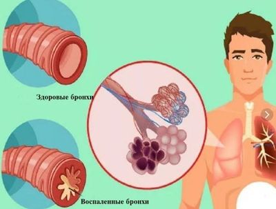 легкие при кашле