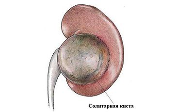 Характеристика солитарных кист почек, причины развития, симптомы, методы лечения