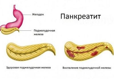 Воспаление ПЖ