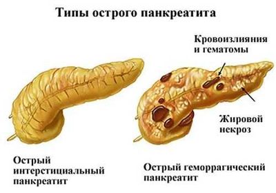 Виды панкреатита