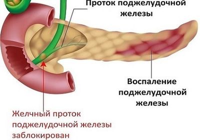определение панкреатита