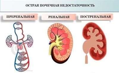 острая почечная недостаточность