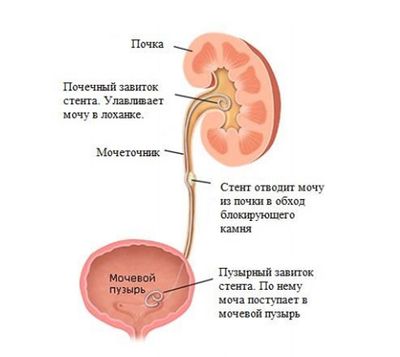 Ретроградное стентирование