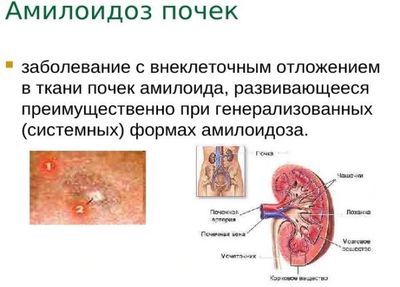 почечный амилоидоз