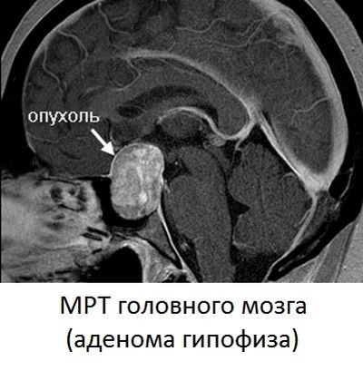Аденома гипофиза головного мозга