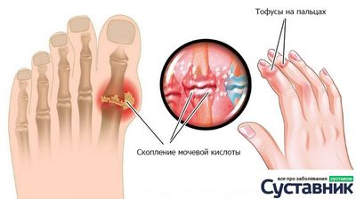 Тофусы