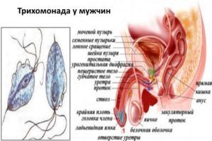 Трихомониаз у мужчин