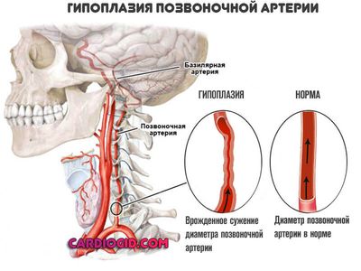 Гипоплазия-позвоночной-артерии