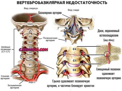 вертебробазилярная-недостаточность