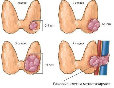 стадии развития рака
