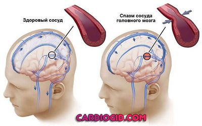 спазм-сосудов-мозга