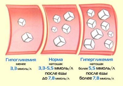 гипогликемия