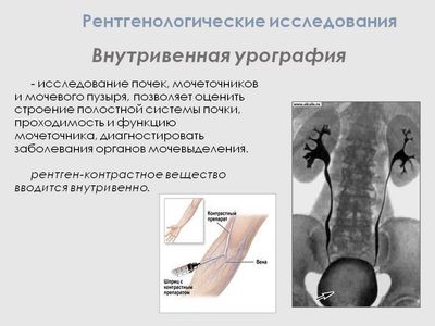 внутривенная урография
