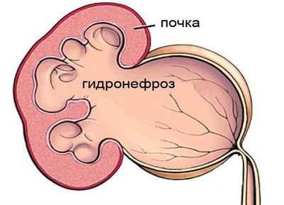 гидронефроз