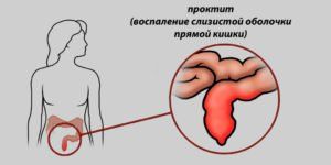 Проктит Проктит