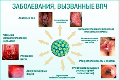 Заболевания, вызываемые вирусом папилломы человека