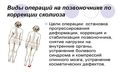 Виды операций на позвоночнике