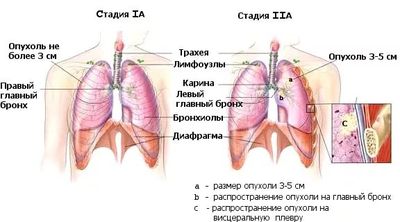 Аденокарцинома лёгкого: стадии, лечение и прогноз