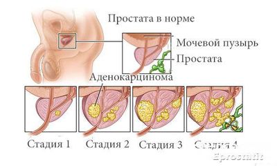 Стадии развития аденокарциномы предстательной железы
