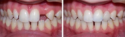 Фото протеза во рту
