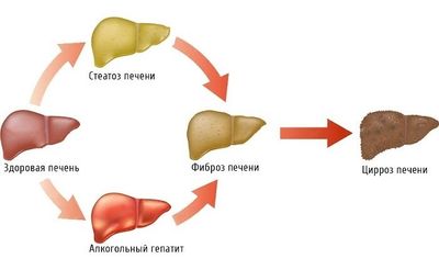 Алкогольный цирроз печени
