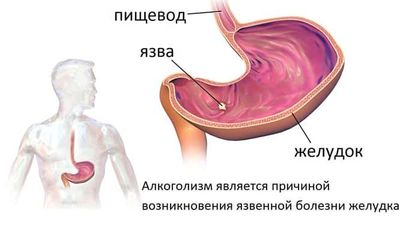 Симптомы и особенности лечения алкогольного гастрита