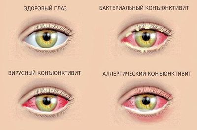 Причины и лечение аллергического конъюнктивита