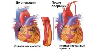 АКШ операция на сердце
